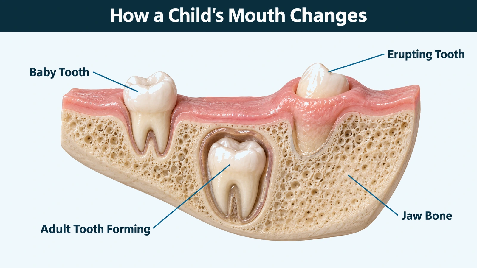Cutaway of a child's lower jaw showing a small baby tooth in place, an adult tooth still forming inside the bone below it, and another adult tooth part way through the gum. Labelled: baby tooth, adult tooth forming, erupting tooth and jaw bone.