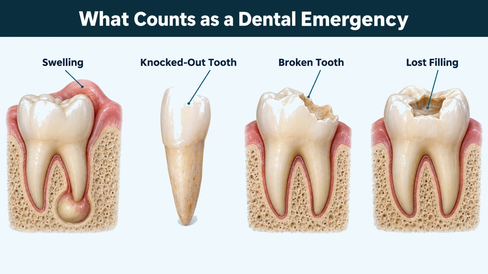 Four calm cutaway studies in a row: a molar with an abscess at the root tip and raised gum above it, a whole adult tooth out of the mouth with its root intact, a molar with part of the crown broken away, and a molar with an empty cavity where a filling was. Labelled: swelling, knocked-out tooth, broken tooth and lost filling.