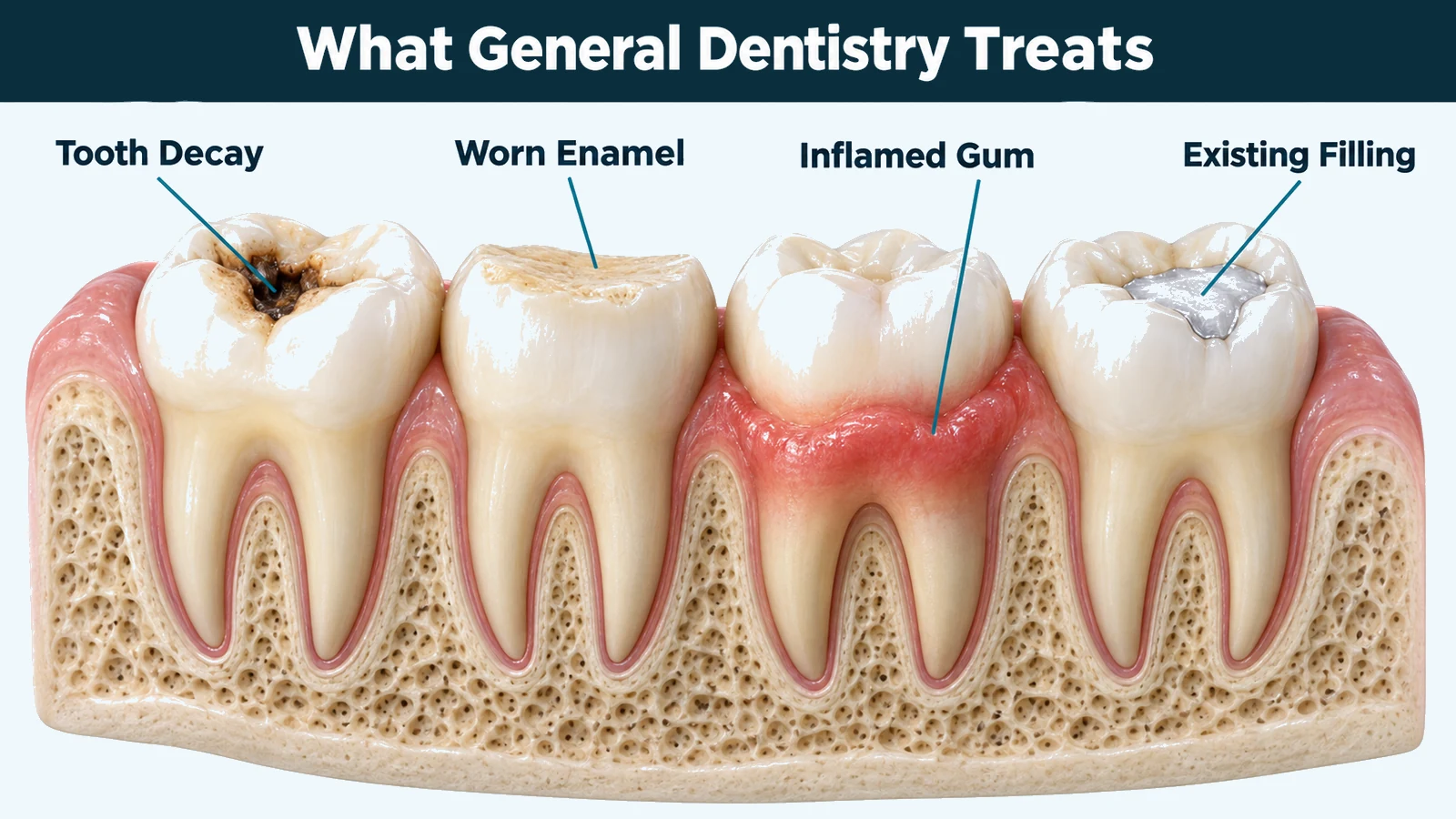 Cutaway of a lower jaw with four adjacent teeth in gum and bone, each showing a different everyday problem: a decay cavity, a worn biting edge, swollen gum, and an existing filling. Labelled: tooth decay, worn enamel, inflamed gum and existing filling.