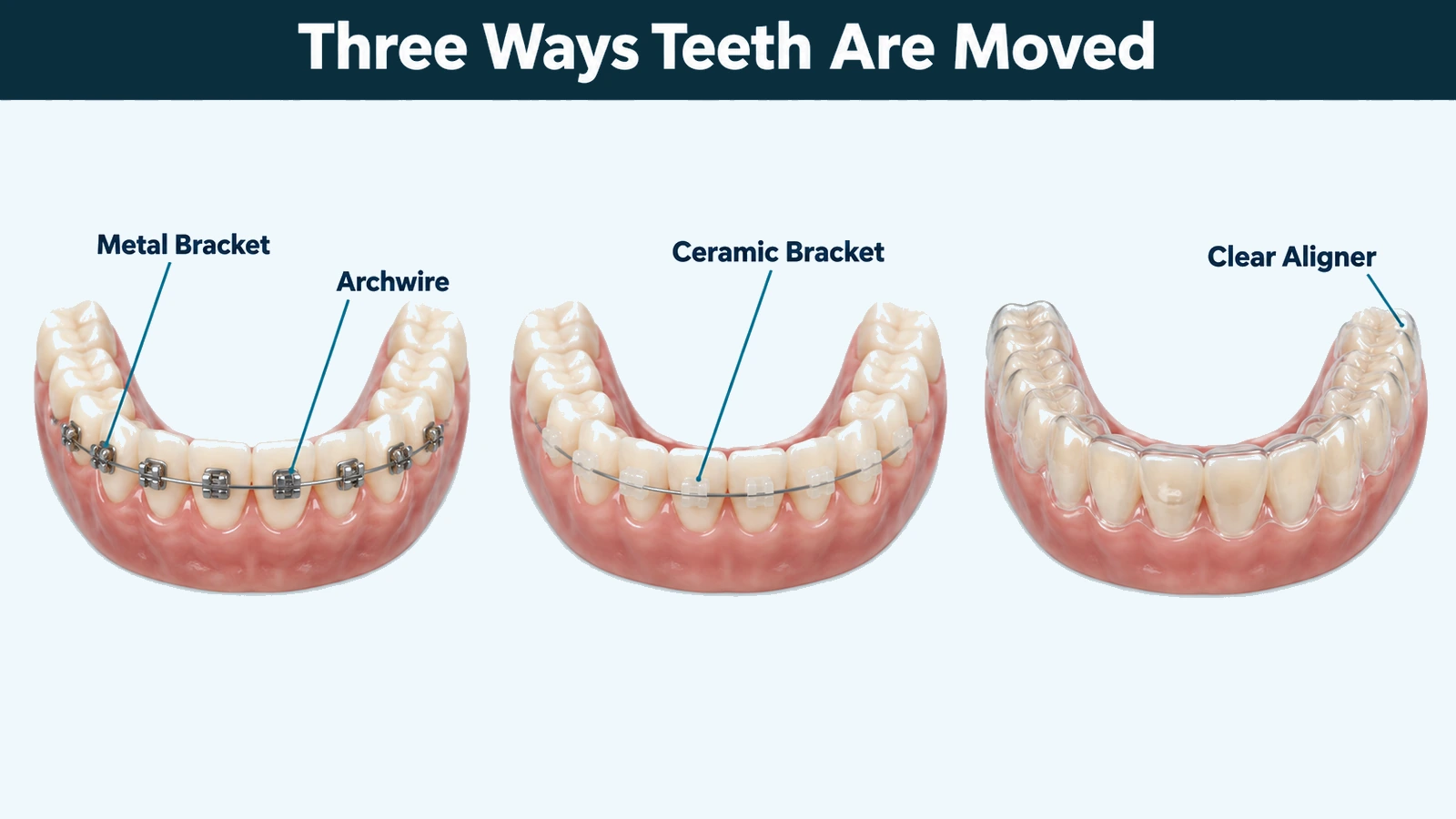 Three sections of a lower dental arch side by side: one with metal brackets and a wire, one with tooth-coloured ceramic brackets and a wire, and one wearing a clear removable tray with no brackets. Labelled: metal bracket, ceramic bracket, clear aligner and archwire.