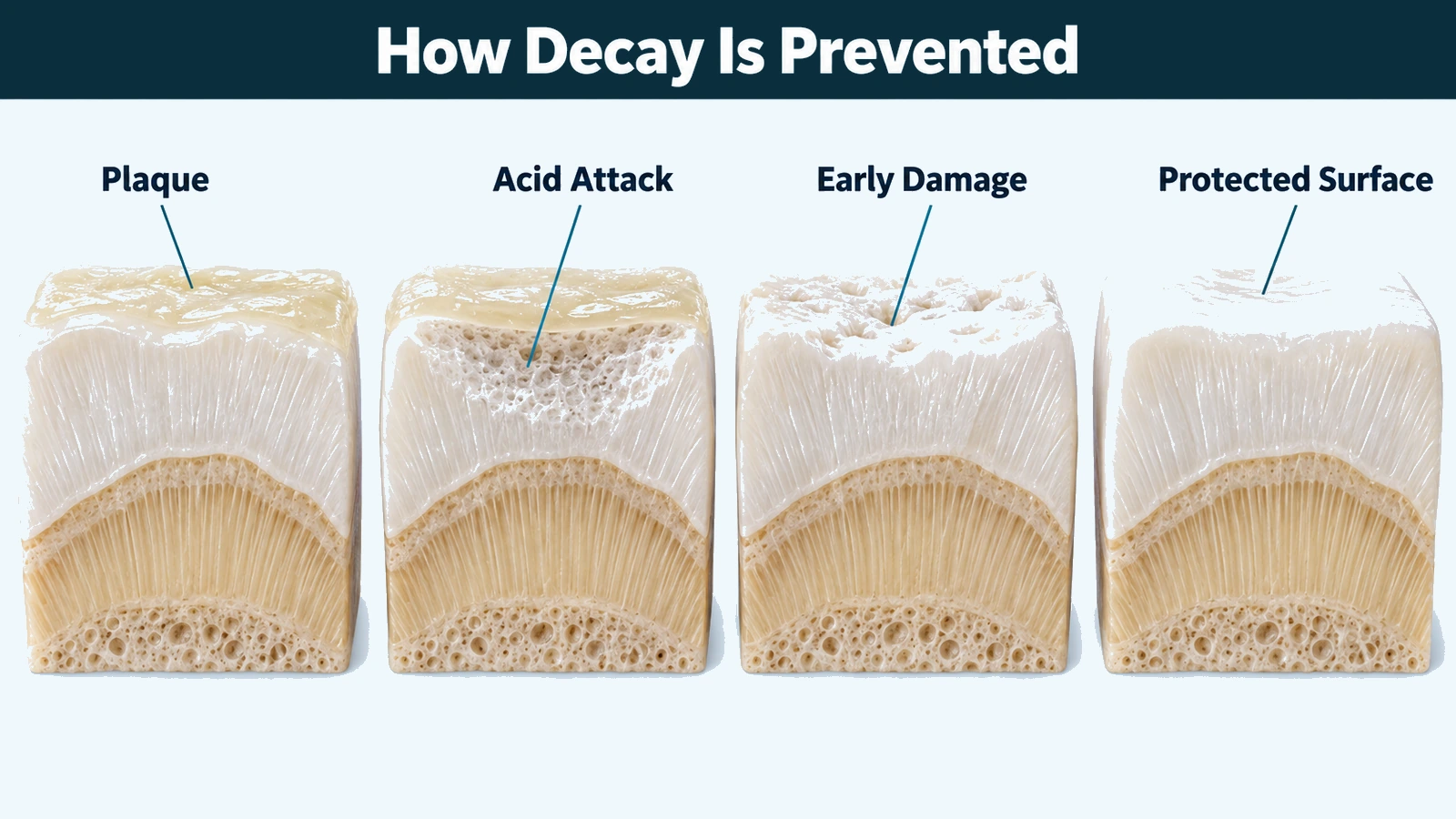 Magnified cutaway of tooth enamel in four stages: a soft film on the surface, mineral being lost beneath it, shallow rough pitting, and the surface sound and smooth again. Labelled: plaque, acid attack, early damage and protected surface.