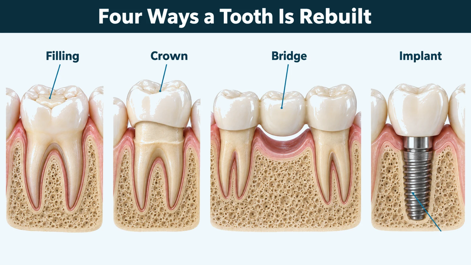 Four cutaway jaw sections side by side showing a filling in a molar, a ceramic crown over a prepared tooth, a three-unit bridge spanning a gap, and a screw implant in bone carrying a crown. Labelled: filling, crown, bridge and implant.