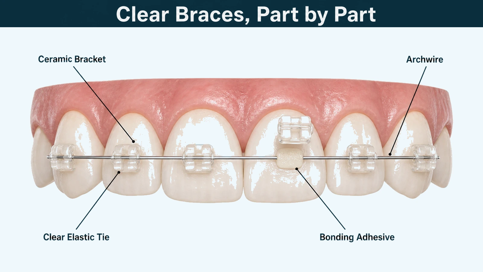 Close view of upper front teeth fitted with tooth-coloured ceramic brackets joined by a thin archwire held in place by clear elastic ties. Labelled: ceramic bracket, archwire, clear elastic tie and bonding adhesive.