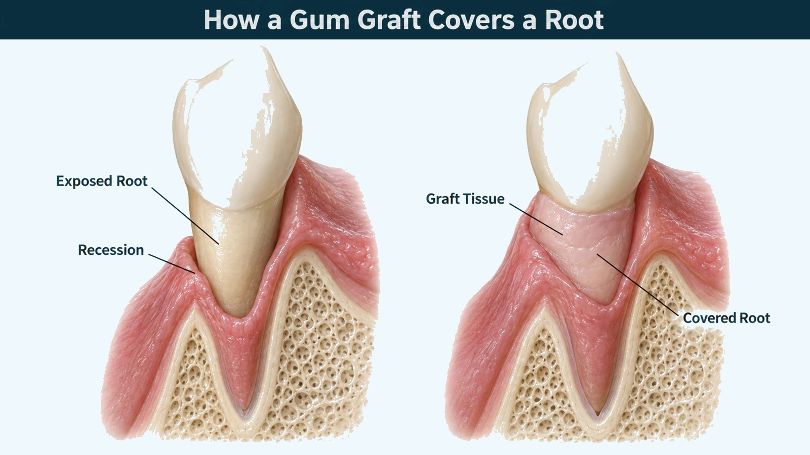 Two cutaway sections of the same lower canine side by side: one with the gum shrunk back leaving a band of bare root showing below the enamel, and one with a thin paler layer of tissue laid over that band and tucked under the gum margin. Labelled: exposed root, recession, graft tissue and covered root.