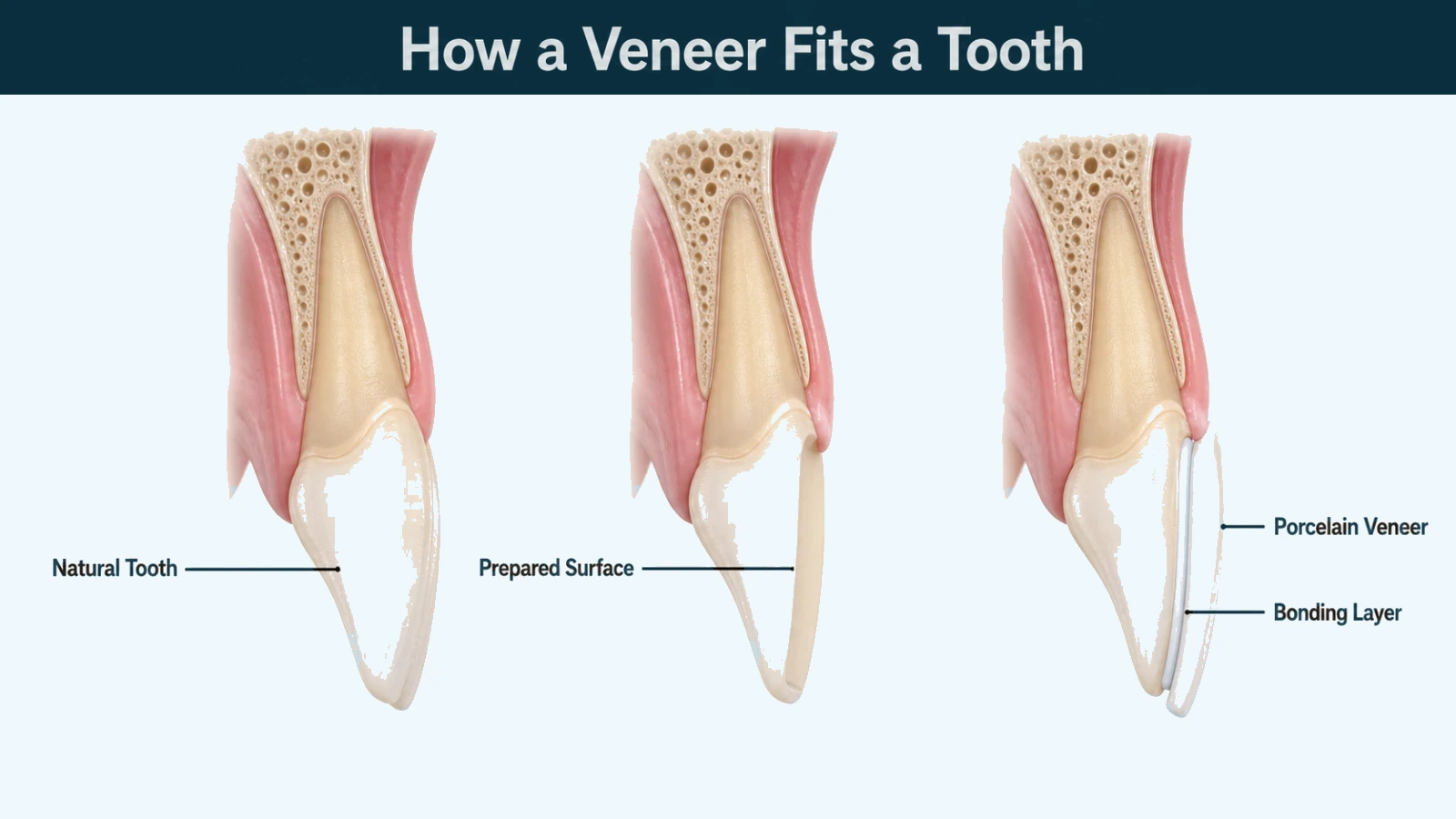 Three cutaway upper front teeth viewed from the side: a natural tooth, the same tooth with a thin layer removed from the front only, and a thin porcelain shell bonded to that surface. Labelled: natural tooth, prepared surface, porcelain veneer and bonding layer.