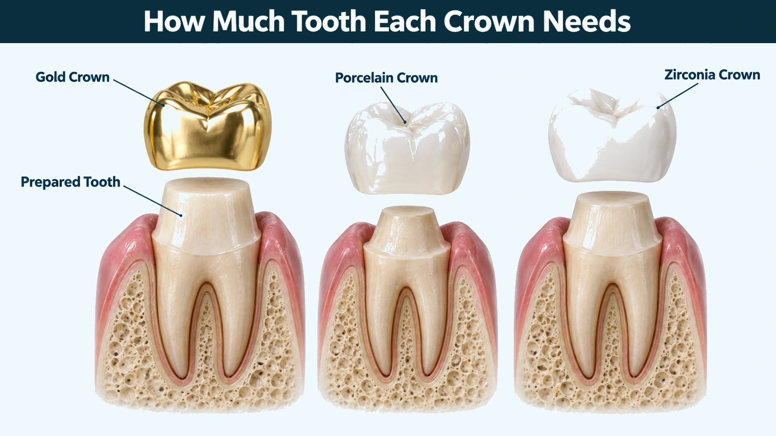 Three cutaway lower molars side by side, each prepared for a crown with its crown floating above the stump: a thin gold crown over a tall lightly reduced tooth, a thick white porcelain crown over a much smaller stump, and a white zirconia crown over a stump between the two. Labelled: gold crown, porcelain crown, zirconia crown and prepared tooth.